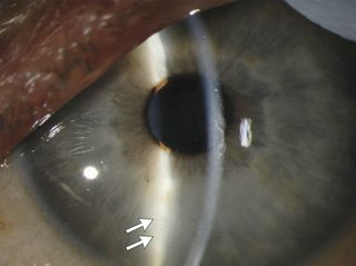 An image of Dr. Ian Crozier's eye after he recovered from Ebola.