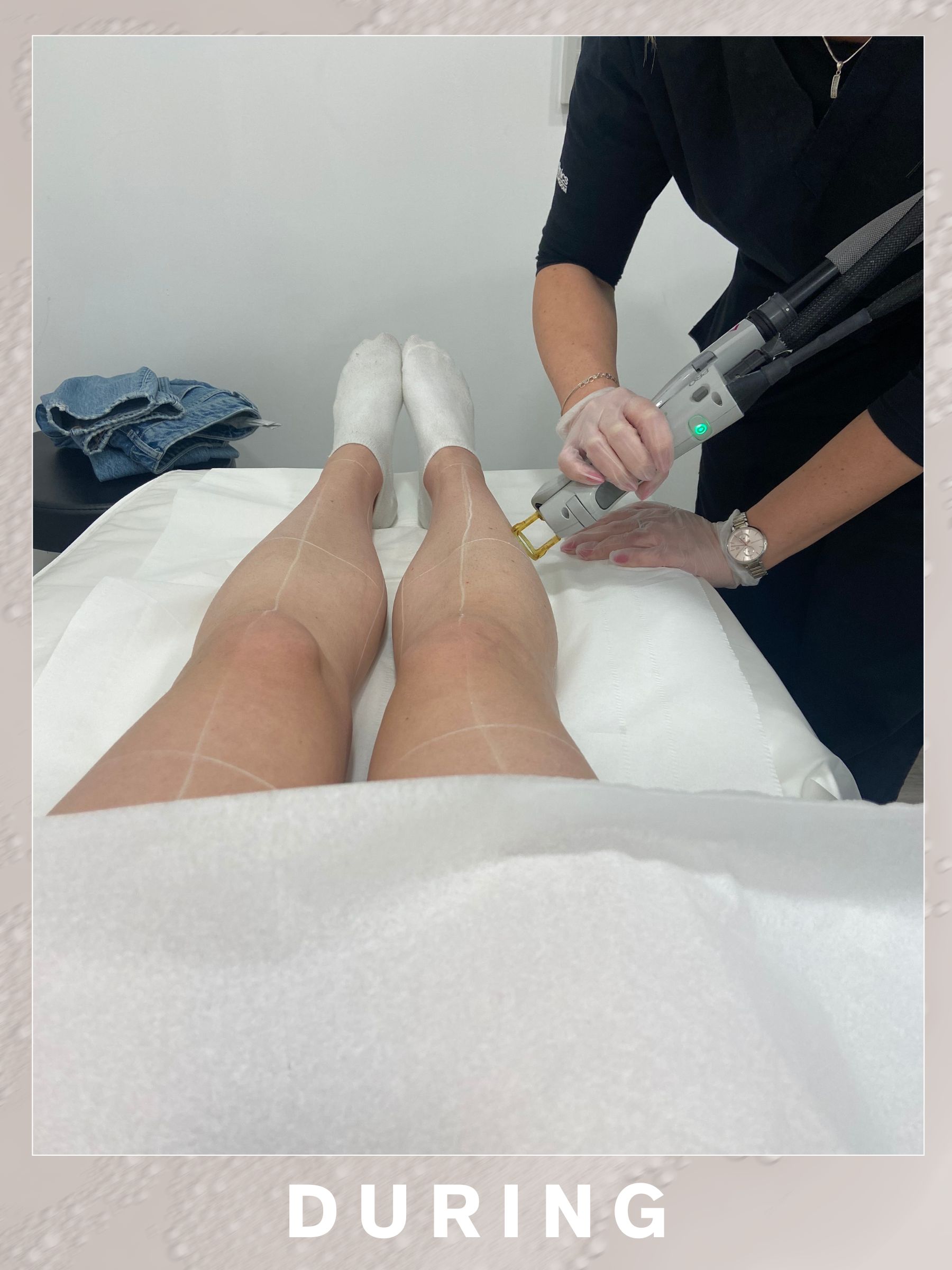 A photo of Eleanor having her legs treated with laser hair removal