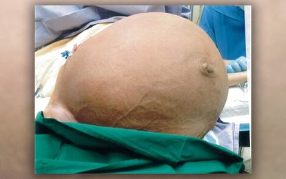 fibroid, case report