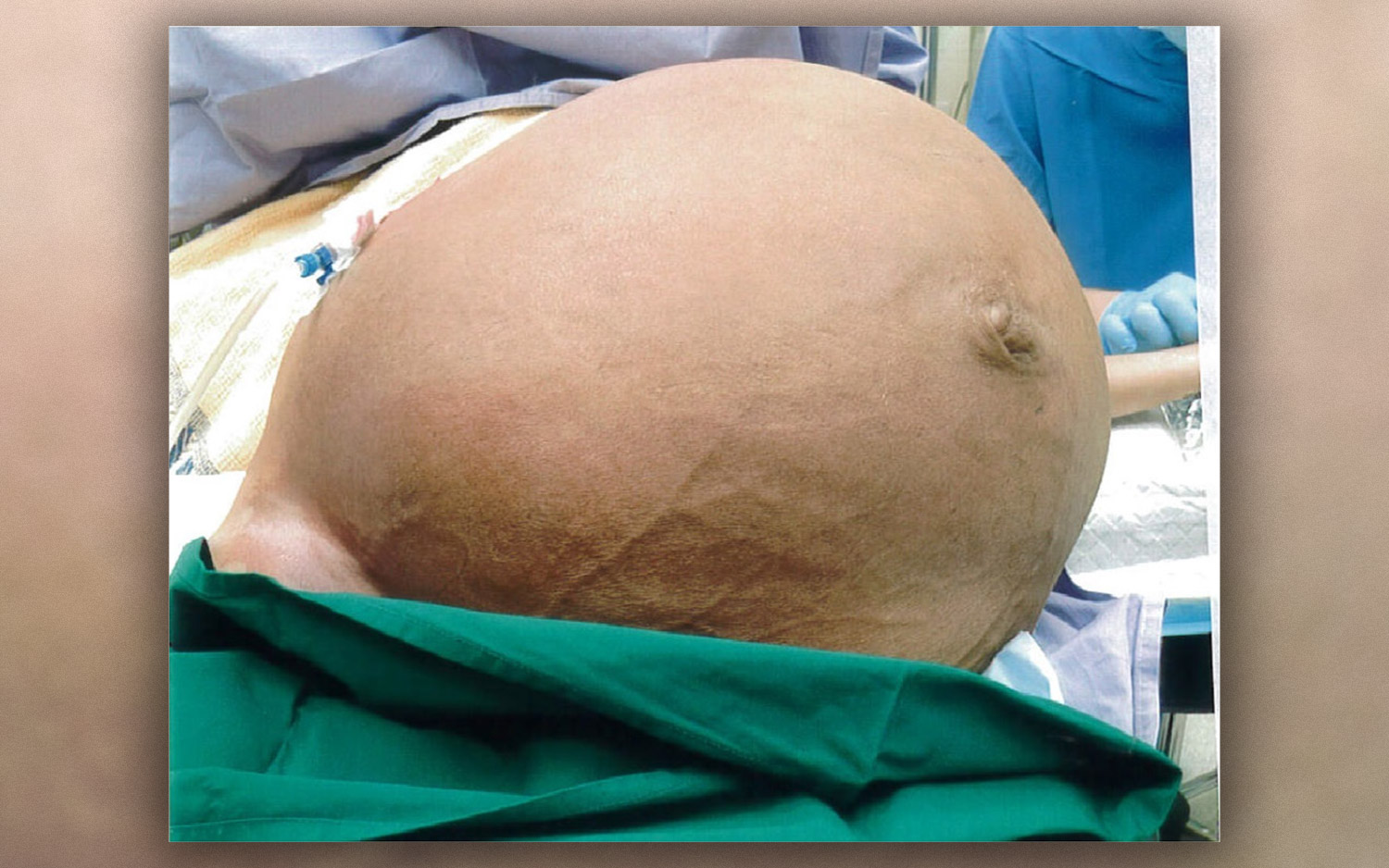 grapefruit size tumor cervical benign