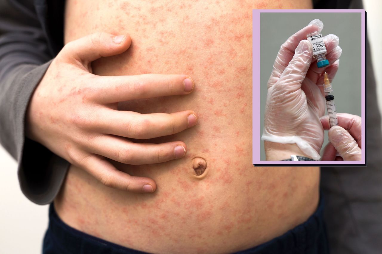 Child with measles rash on tummy and drop in of MMR vaccine needle