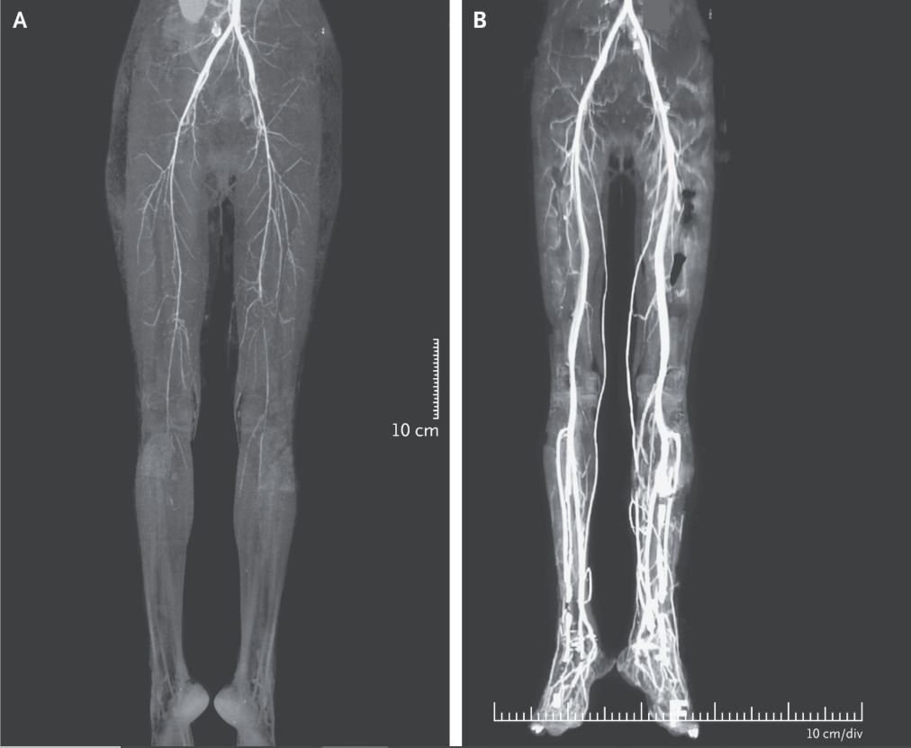 A burning pain in a woman&#039;s legs was due to ergotism, a disease that causes restriction of blood flow. The image shows a CT scan of the woman&#039;s legs before and after treatment for the disease.