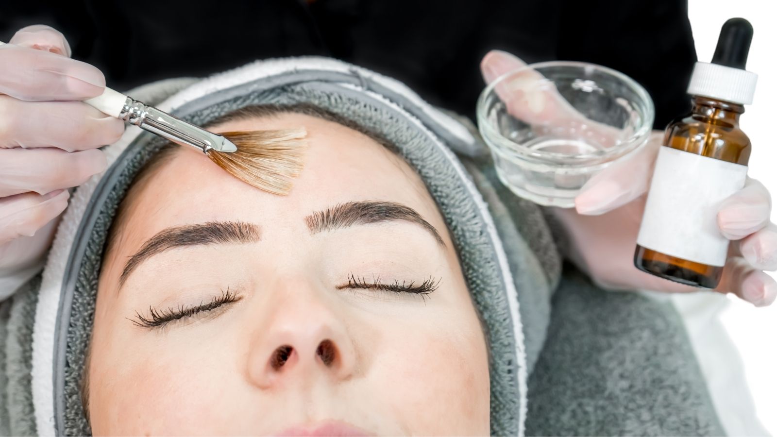 A woman receiving a chemical peel treatment for acne scars