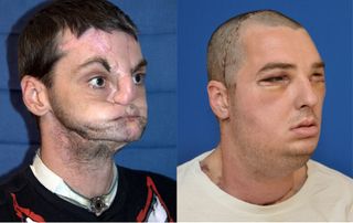 Richard Norris received a face transplant in 2012. Norris had lost a large portion of his in a 1997 gun accident.