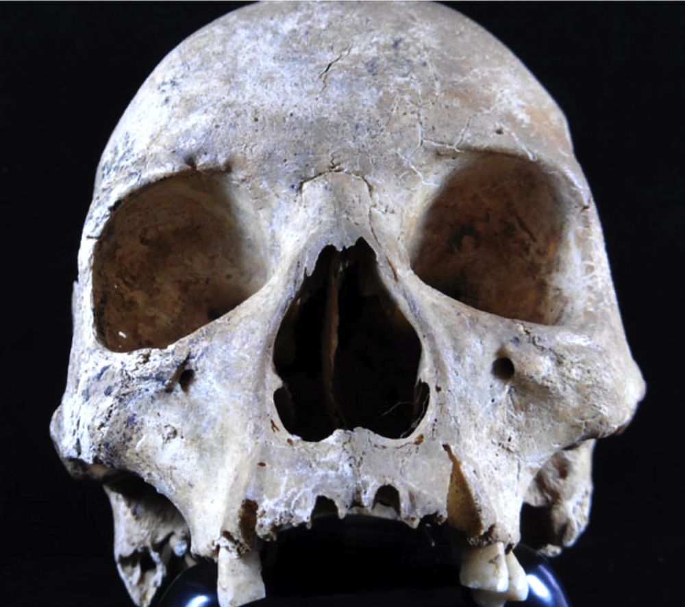 leprosy skull