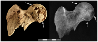 Femur Lesions