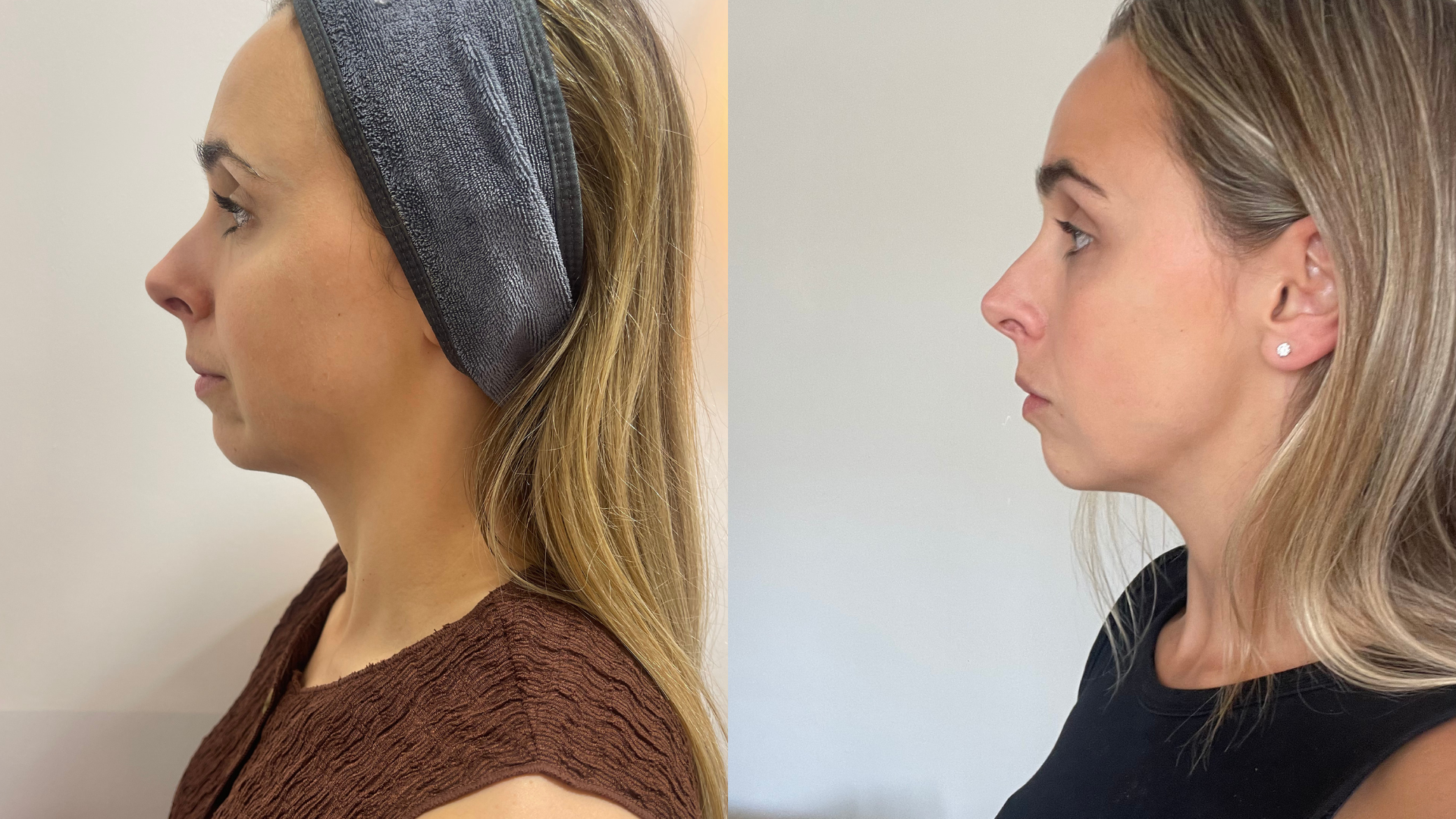 Emma straight after HIFU (L) and three months later (R)