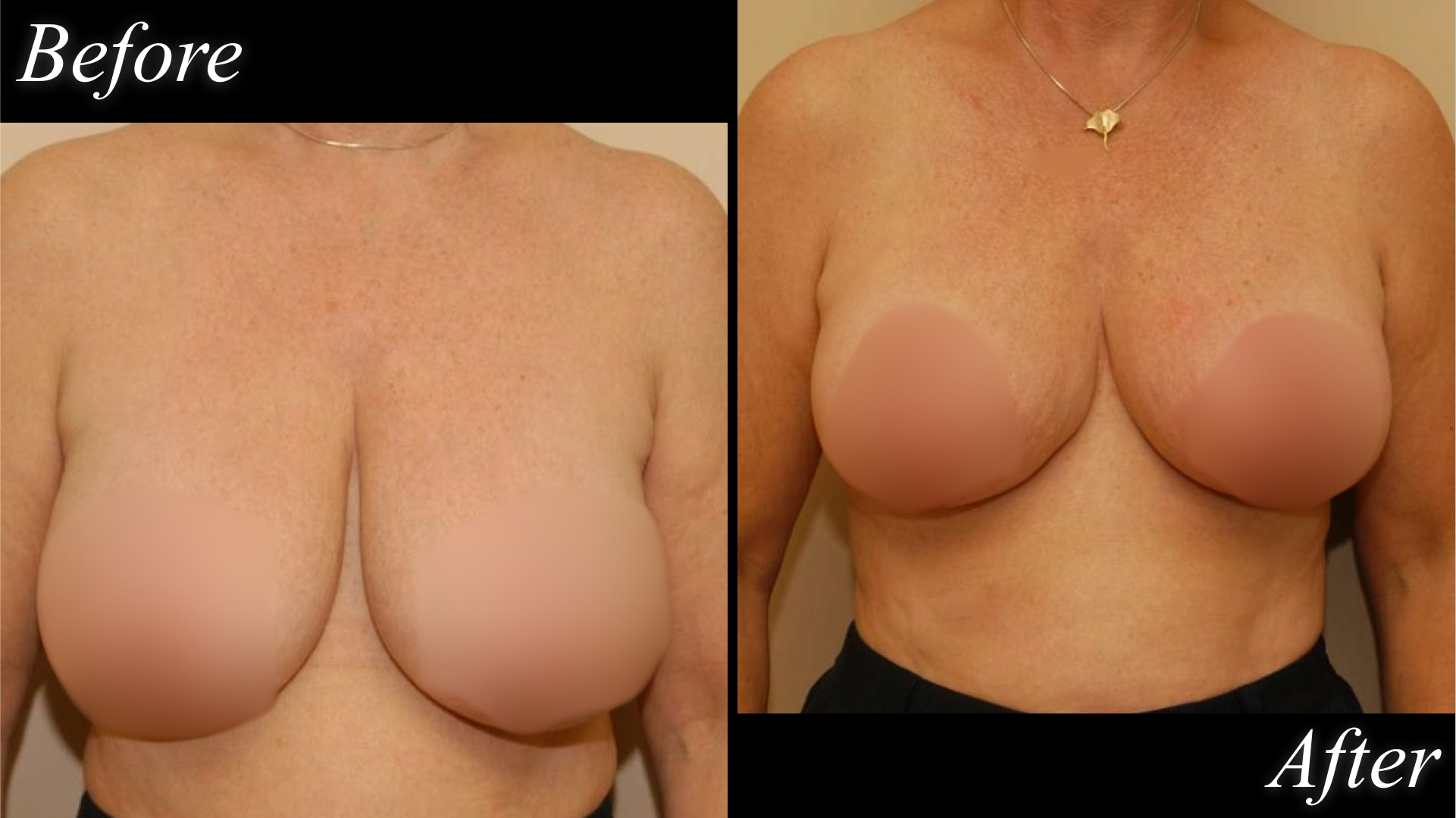 breast reduction before and after picture