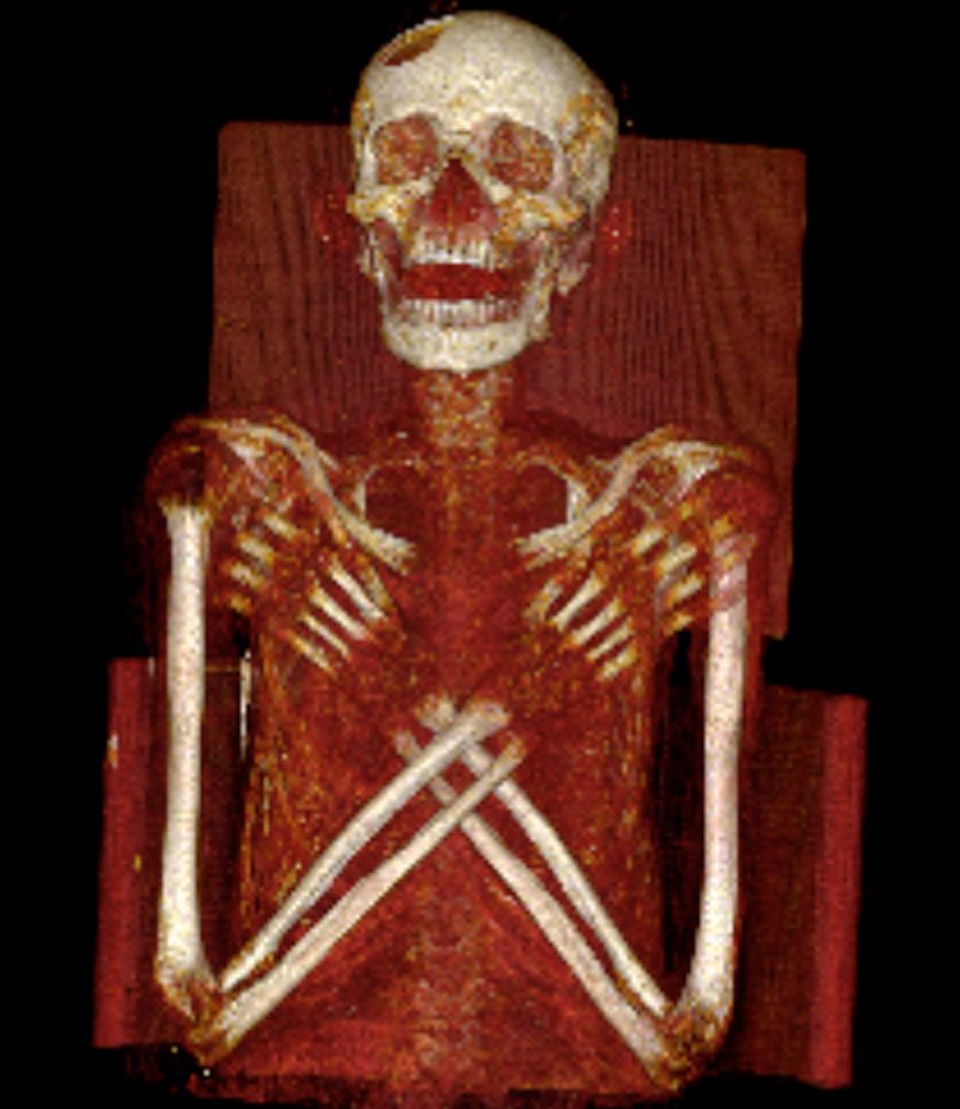 Ancient Egyptian Mummy Suffered Rare Disease Mummy Science Live Science