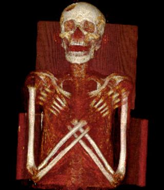 Ancient Egyptian Mummy Suffered Rare Disease | Mummy Science | Live Science