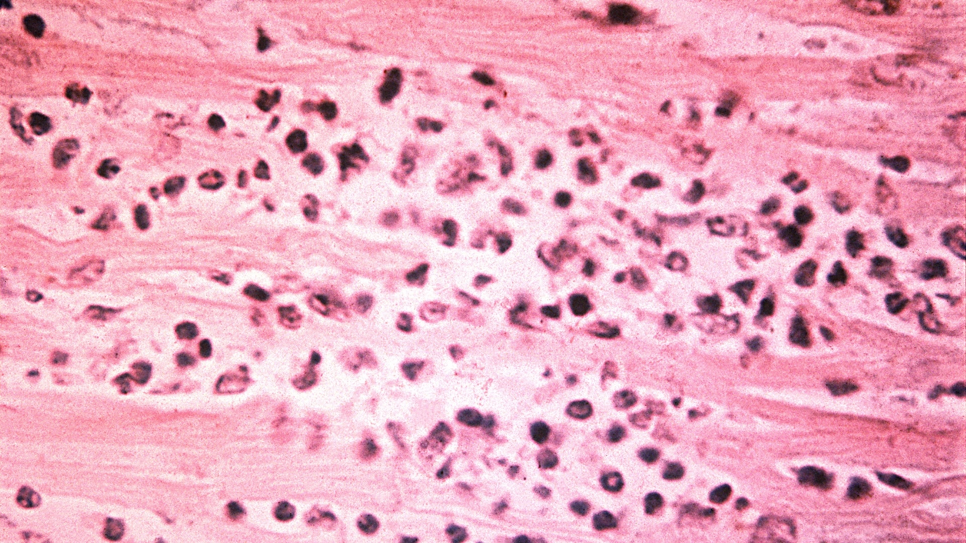 This photomicrograph of a myocardial tissue specimen revealed histopathologic changes brought on by a case of typhoid fever, caused by the bacterium Salmonella enterica serovar Typhi.