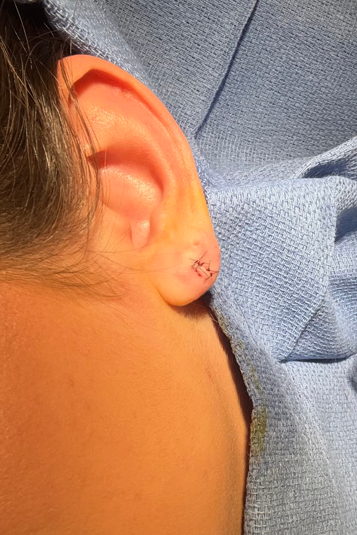 an image of a close-up ear on the operating table after removing the stretched piercing hole and small sutures on the ear afterward