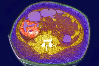 A CT scan showing a tumor in the lower abdominal cavity.