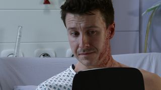 Ryan Connor looks at his acid attack injuries on his face in Coronation Street