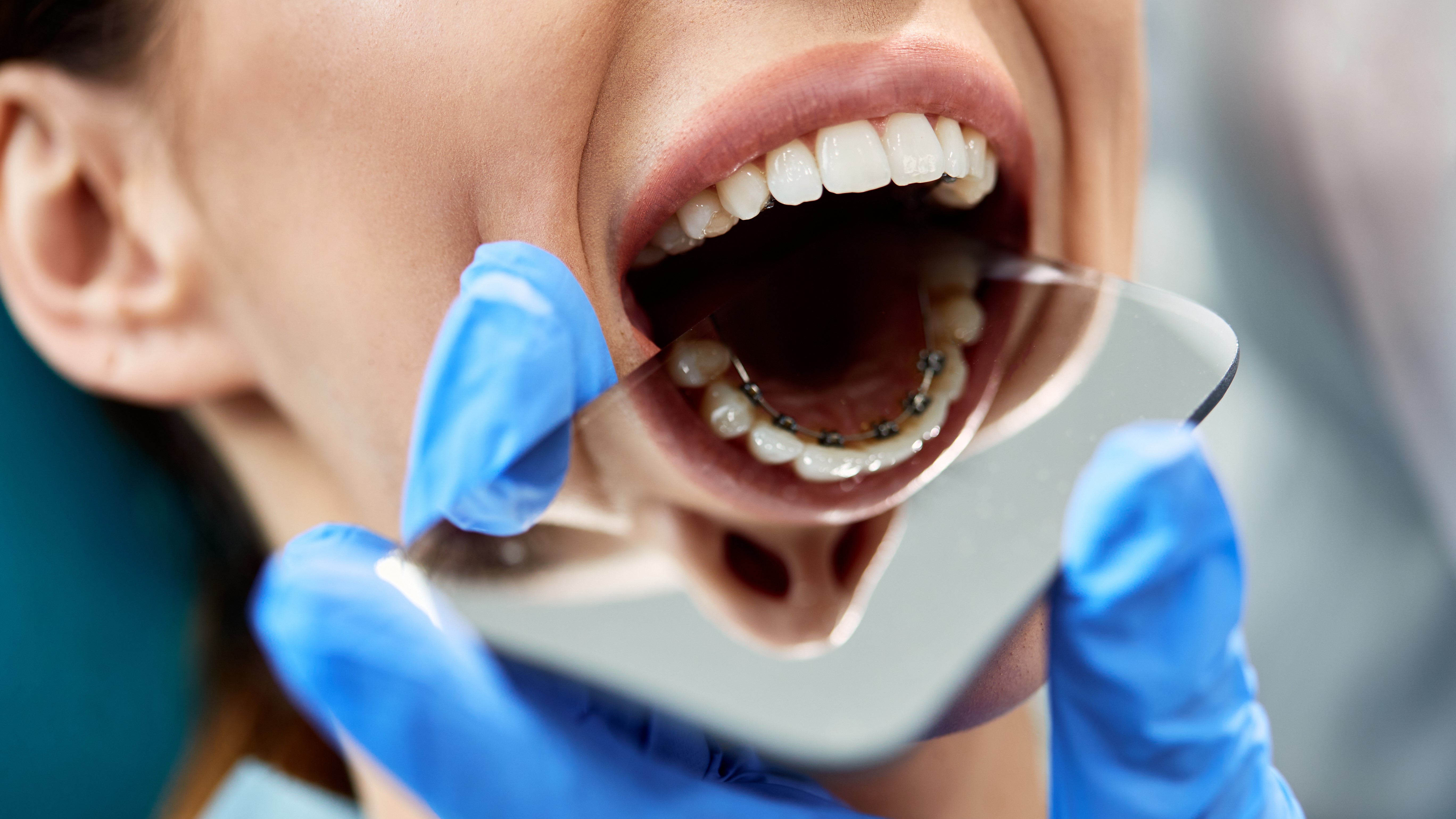 The four types of braces explained by dental experts Woman & Home