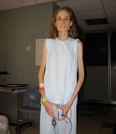 Starvation Nation: Inside a Groundbreaking Eating Disorder Facility ...