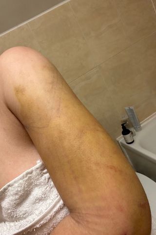 Airsculpt bruising during recovery