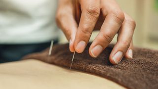 close up of an acupuncturist applying a needle to a person&#039;s bare back