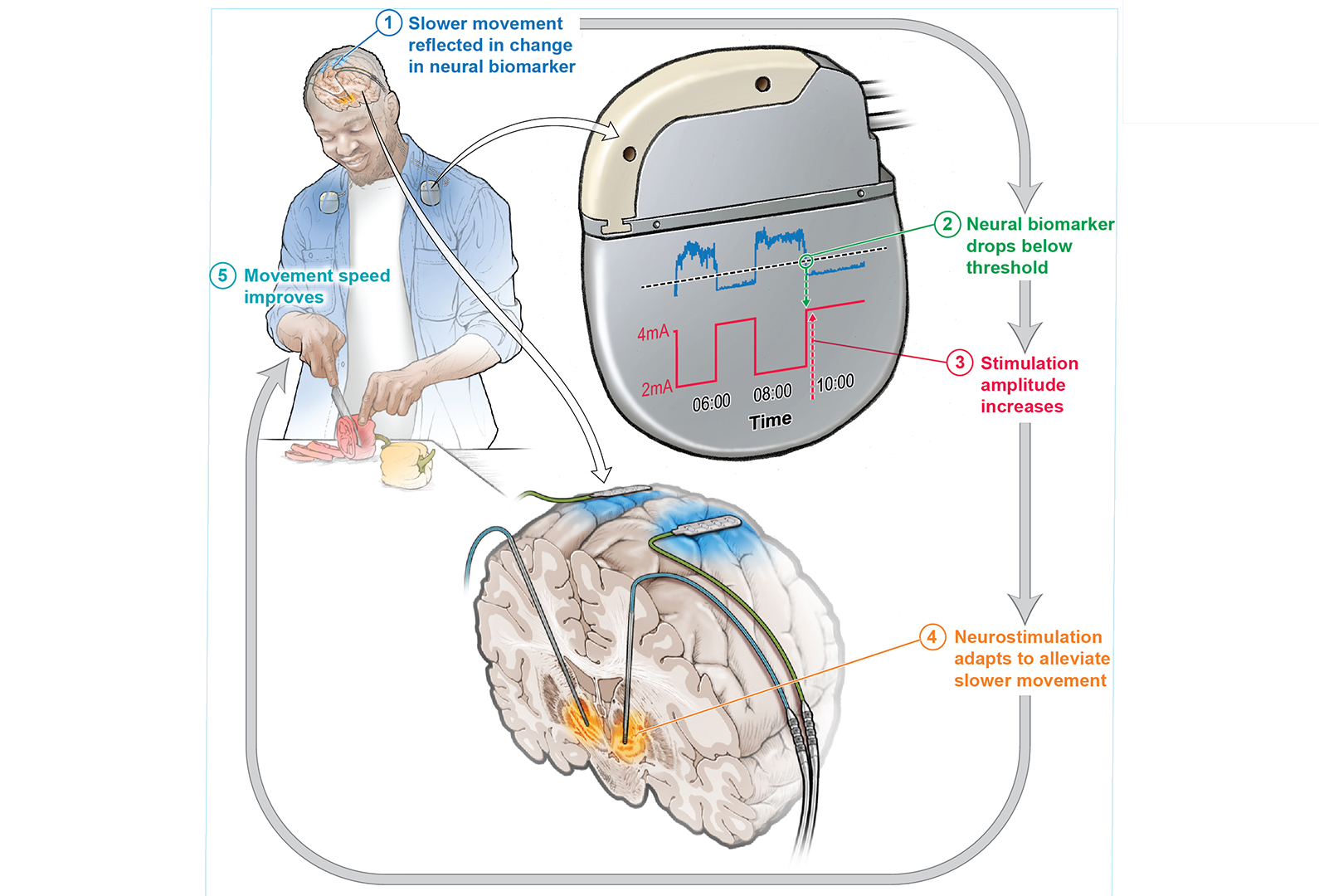 Actual-time mind stimulation slashes Parkinson’s signs by way of part in trial