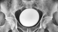 x ray of a pelvis showing a very large white orb at its center