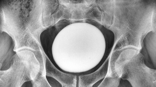 x ray of a pelvis showing a very large white orb at its center
