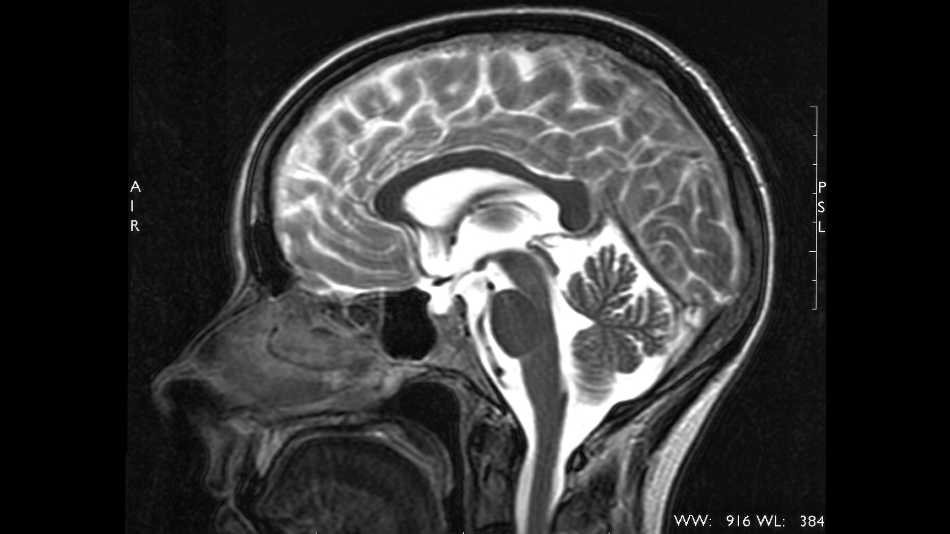 MRI scan