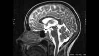 MRI scan