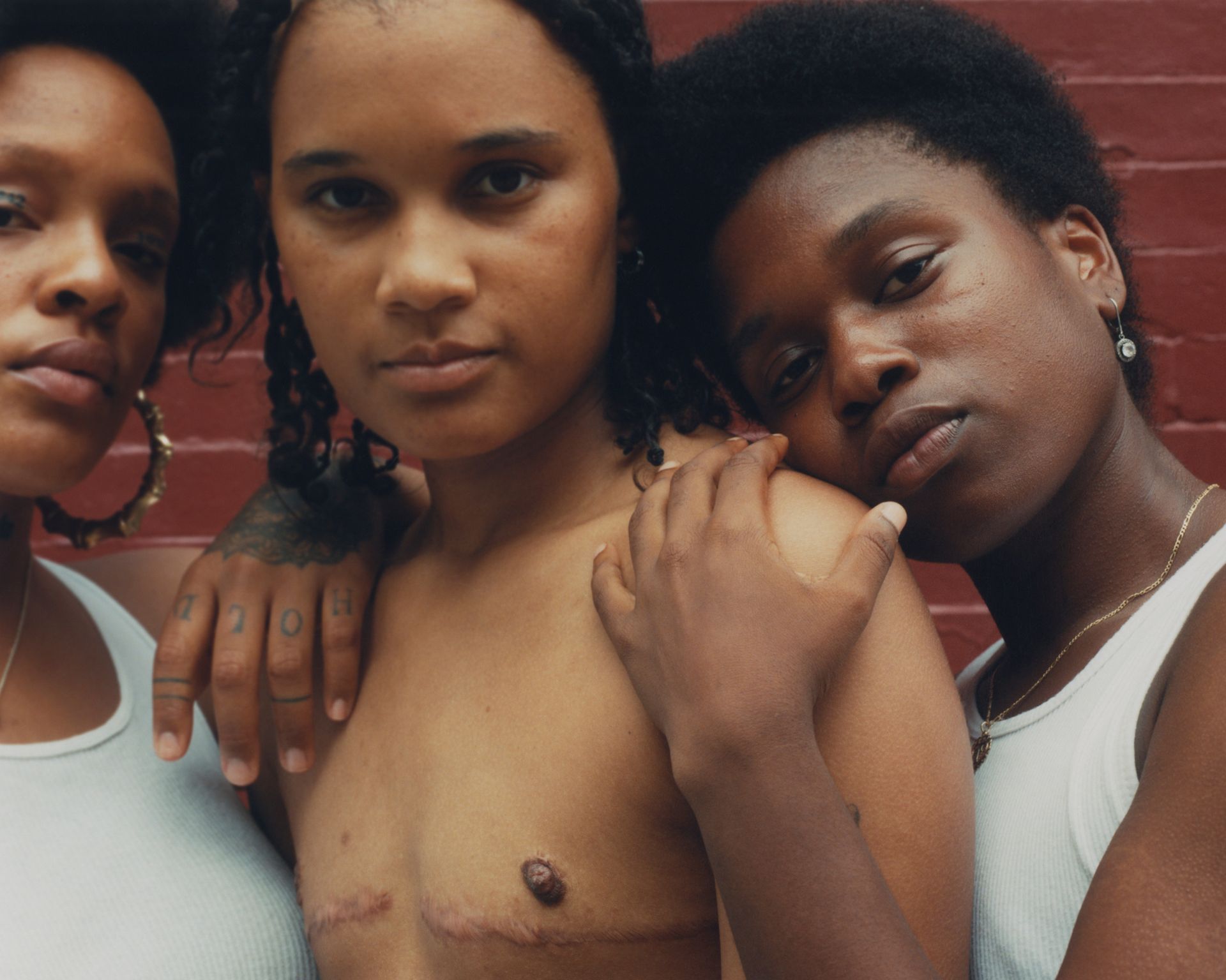 Photo of young transmasculine people, one with scars from surgery