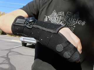 It's still early days but this Boxer's Fracture Brace from Exos Medical seems to be huge improvement over traditional plaster or fiberglass casts.