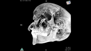 A CT scan of the skull of Seqenenre Taa II, whose facial wounds suggest a violent battlefiend death.