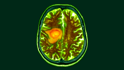 Coloured computed tomography (CT) scan of a section through the brain of an 84-year-old female patient with glioblastoma (dark, left). Glioblastoma is the most aggressive form of brain cancer.