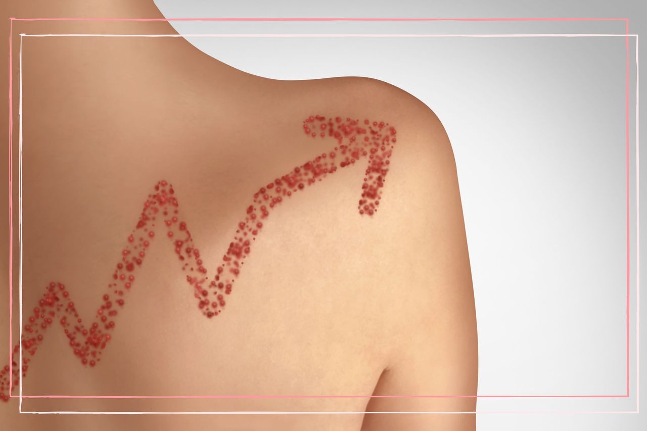 Increase in measles concept in a 3D illustration style showing a rash in the shape of a graph on someone&#039;s back