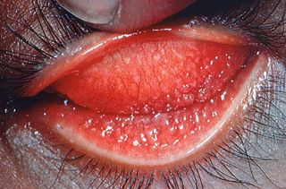 Eyelid inflammation caused by the Chlamydia trachomatis bacterium, known as trachoma. The disease is the leading cause of preventable blindness in the world today and has infected humans for millenia.