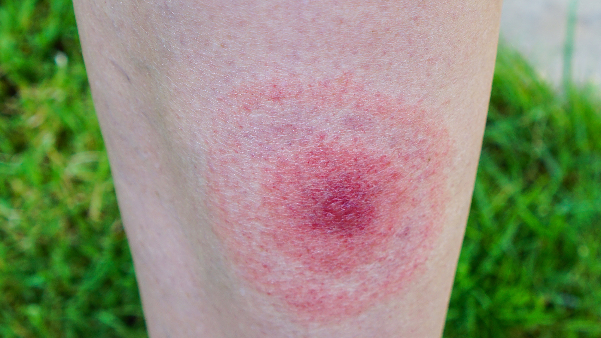 Skin infected with tick bite