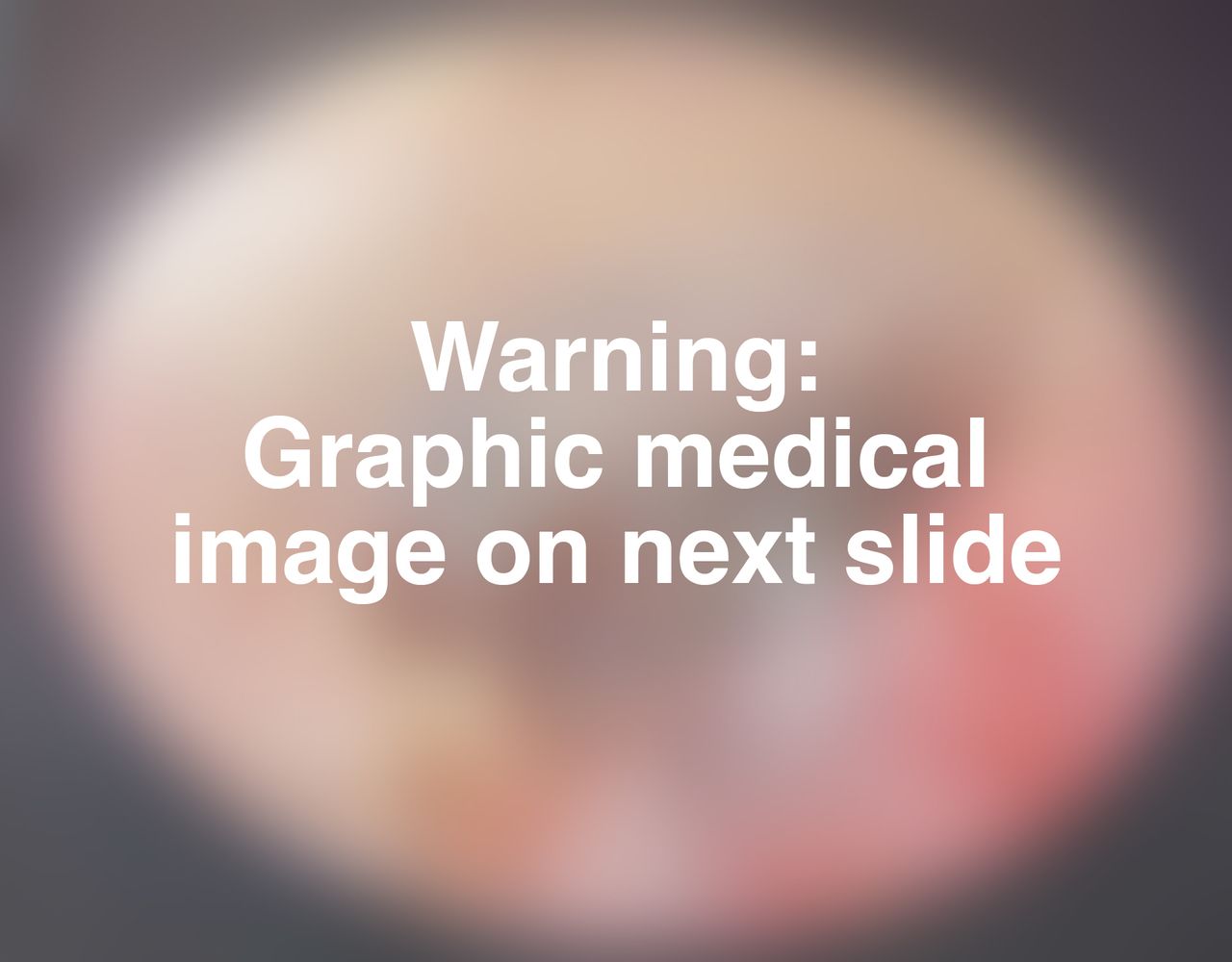 Blurred out image of a tick in a woman's ear