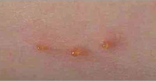 One participant had an immediate reaction to the tick bites, and two days later, developed fluid-filled bumps known as "weeping" vesicles, shown above.