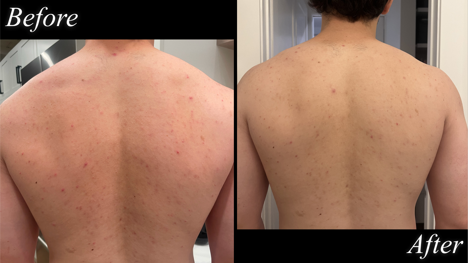 Victor Malzahn before and after testing Cerave acne body wash