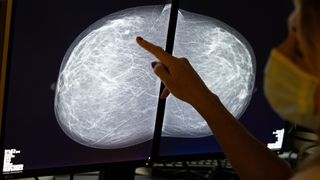 A woman points to a mammogram image on a screen