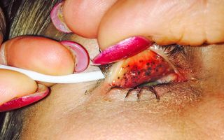 A woman who had a habit of not washing her mascara off developed darkly pigmented lumps under her eyelid, caused by the buildup of bits of mascara.