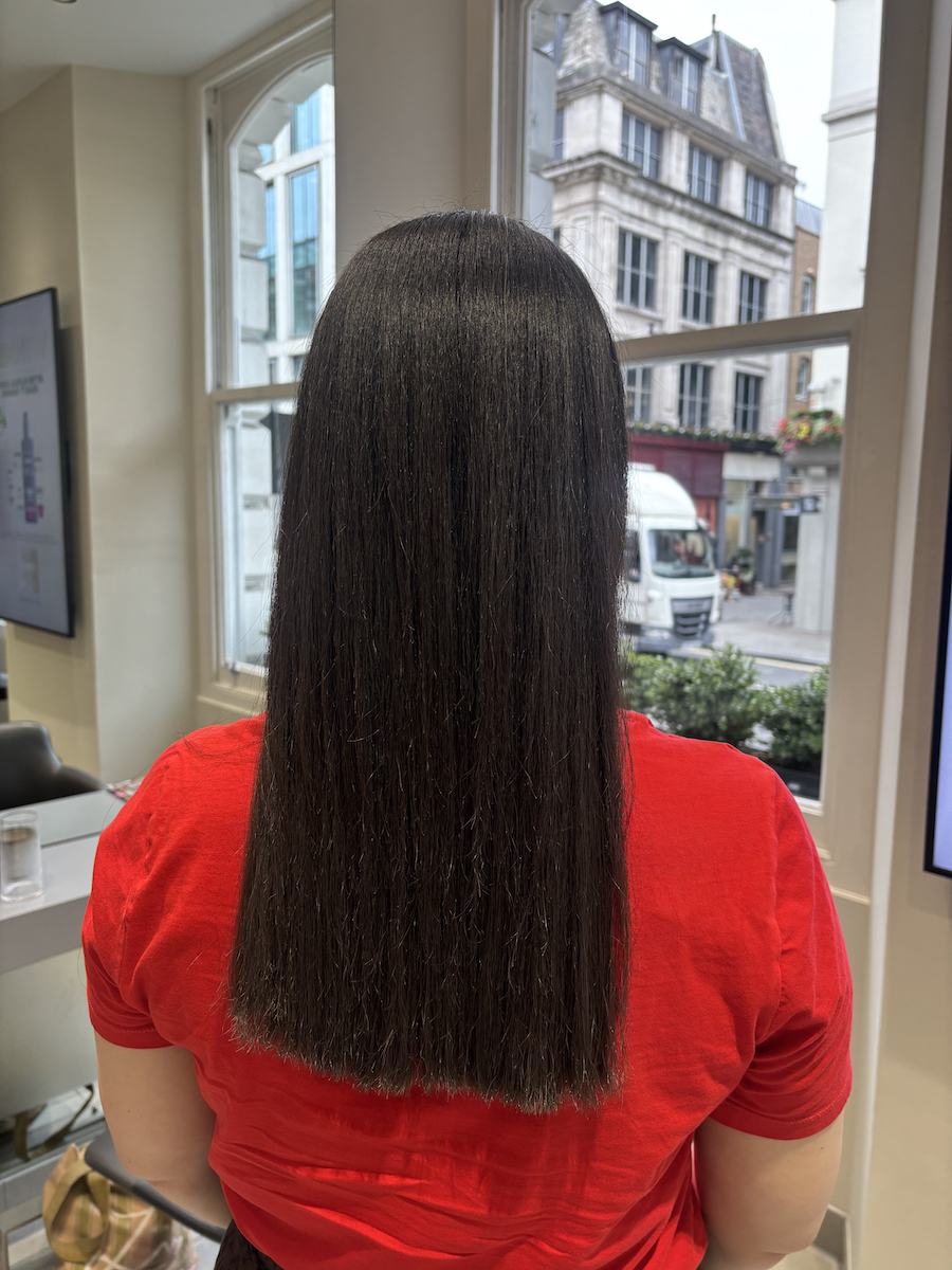 Mica Ricketts after SmoothFiller treatment