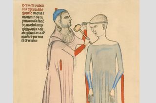 Medieval doctor cutting open a patient's skull with a hammer and blade. Illustration from a 14th century French medical manuscript by Guy of Pavia.