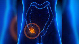 Medical illustration of the gastrointestinal tract of the body in blue with the appendix shown in orange and circled