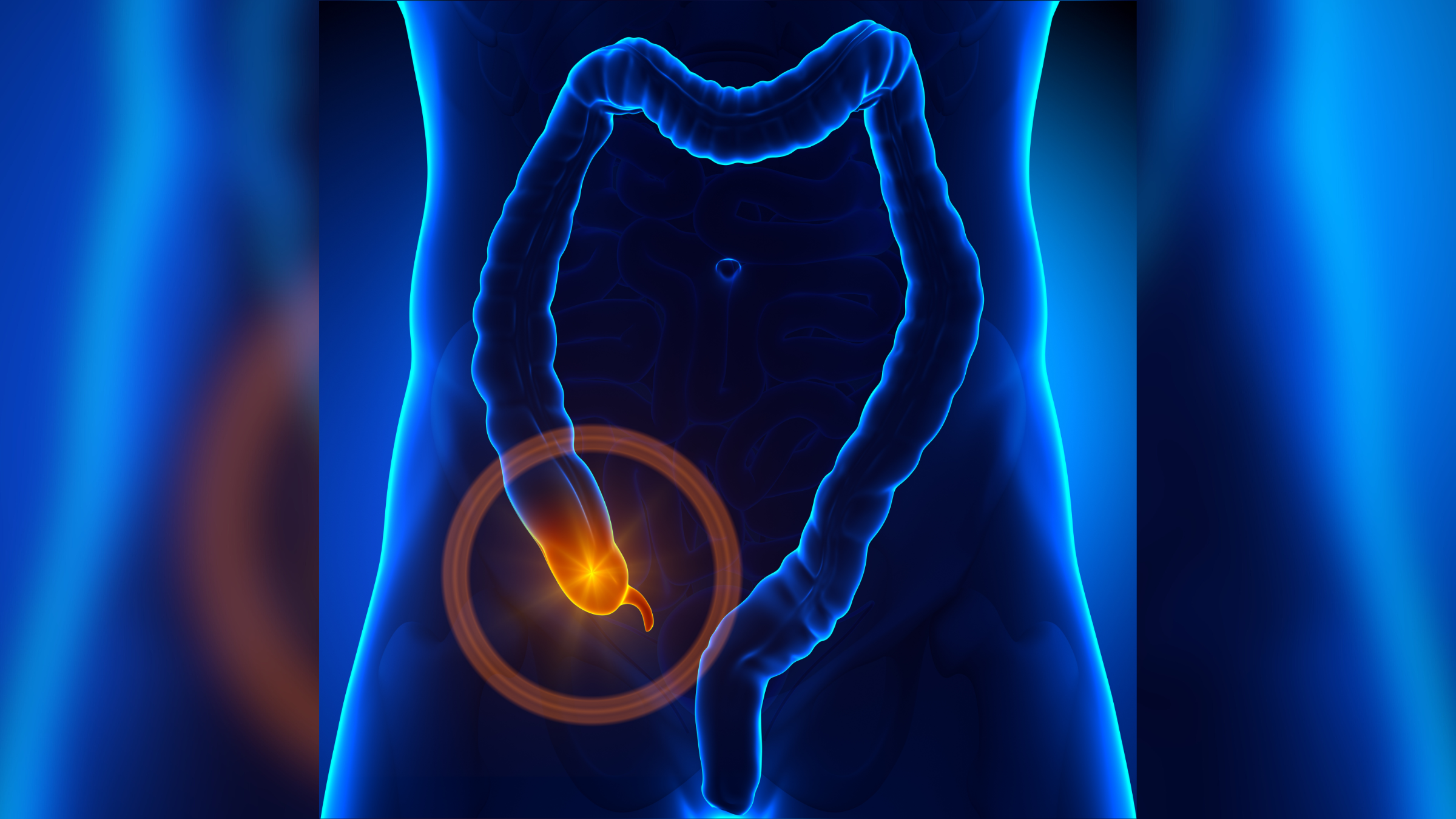 Medical illustration showing the body's digestive tract in blue and the appendix circled in orange