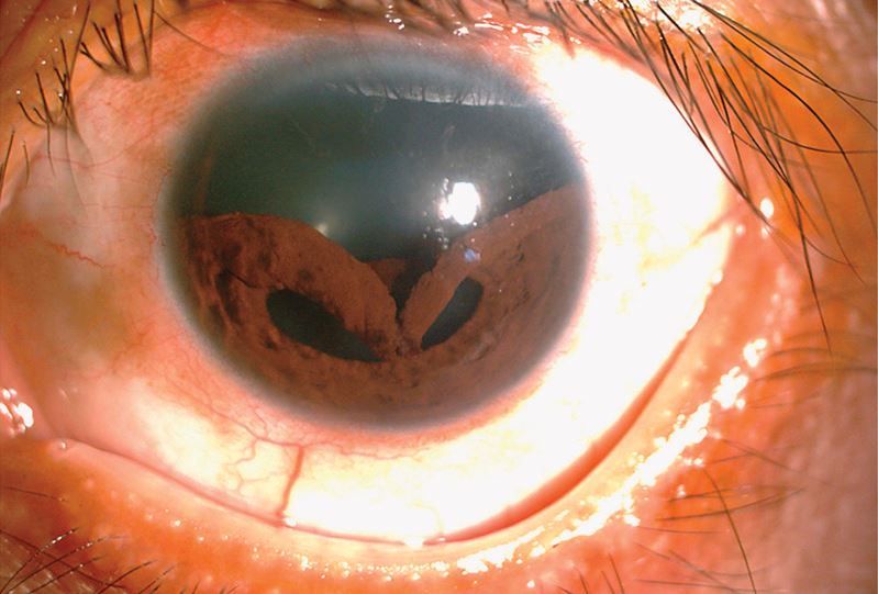 A man in Taiwan was diagnosed with a painful eye injury called &quot;traumatic iridodialysis,&quot; in which the iris detaches from it&#039;s normal place. In this case, the iris detached at the top, and appears to be sagging downward.