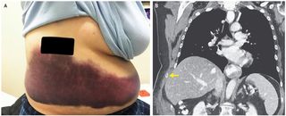 A woman with whooping cough broke her rib while coughing. On the left, an image of the large bruise that developed on the woman's side. On the right, a CT scan image showing her fractured rib.