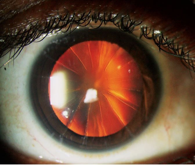 A woman&#039;s eye exam revealed 16 cuts on her eyeball arranged in a radial pattern, due to a now-outdated eye surgery. (The fiery-red appearance of the woman&#039;s pupil is simply due to the red-eye effect in the photograph.)