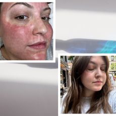 Freelance beauty writer Sophia Vilensky's skin after a microneedling and exosome treatment at Haus Salon in Minneapolis.