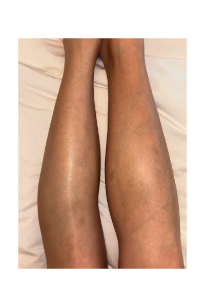 Olivia M., a ‘Marie Claire’ tester, tests the Rose Skin Co. Lumi IPL Permanent Hair Removal Device