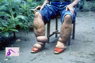 Elephantiasis caused by parasitic worms (inset) affects more than 120 million people, primarily in Africa and Southeast Asia.
