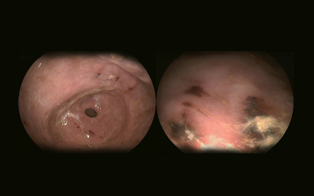 Bleed-in-Ulcers-3-and-4